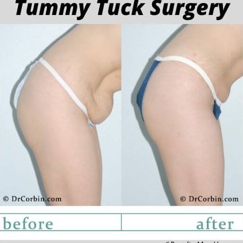 tummy tuck